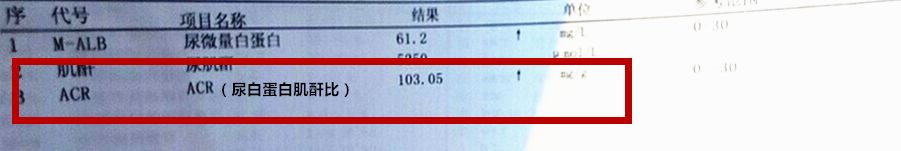 臨床目前最常用尿蛋白肌酐比來反應(yīng)尿微量白蛋白的水平